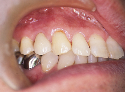 オールセラミッククラウン治療について | 医療法人 福冨士会 京都